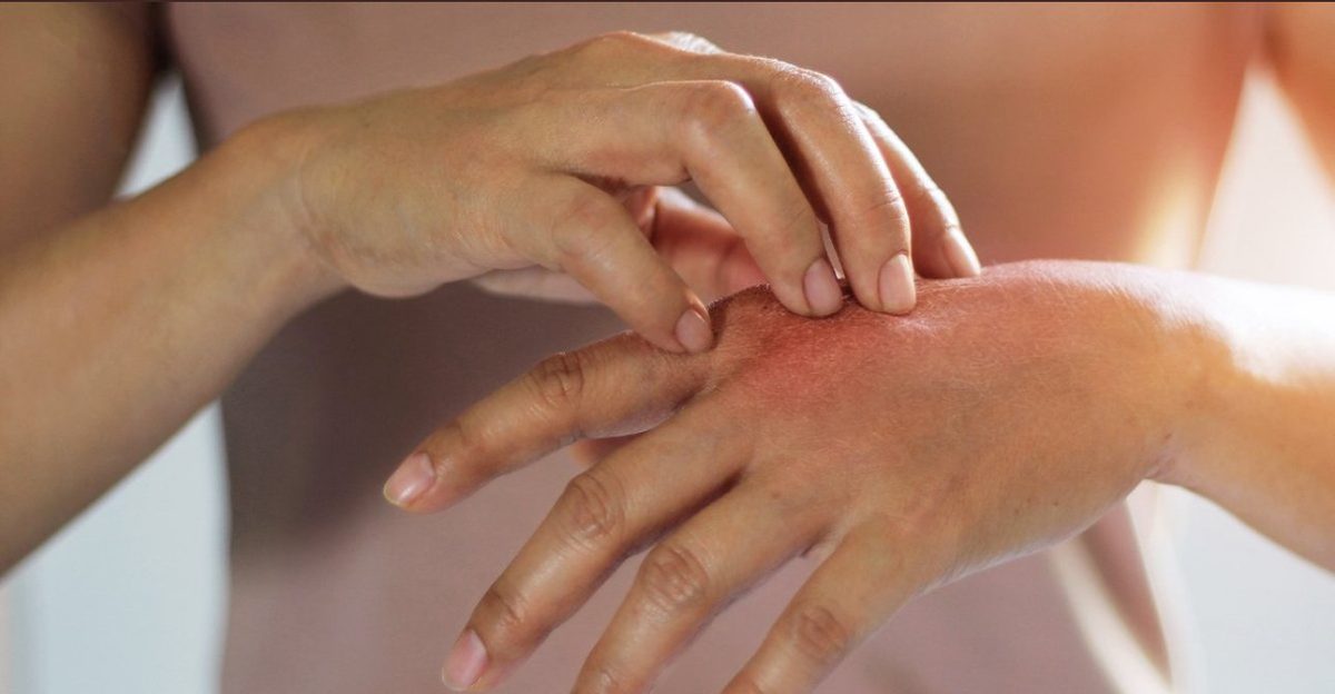 الطفح الجلدي.. مؤشر مبكر للإصابة بـHIV