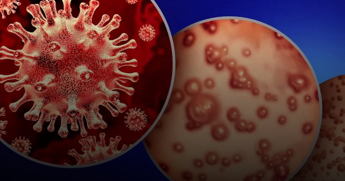 بدء اجتماعات لجنة الطوارئ الصحية الدولية بشأن تزايد تفشي جدري القرود