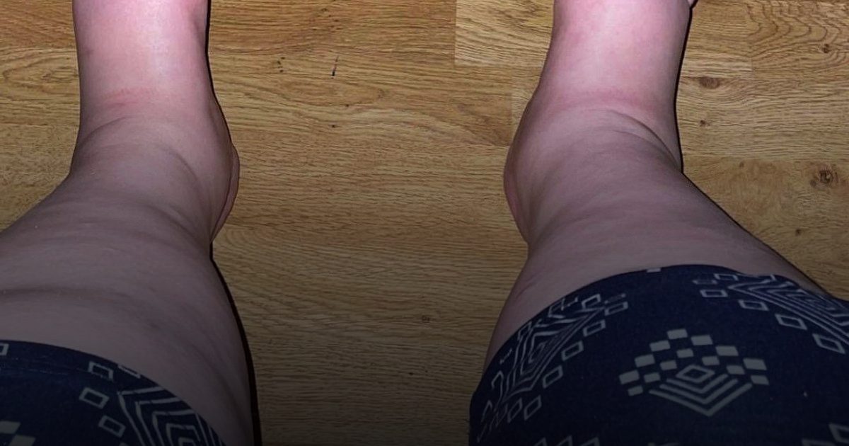 أزمة تورم القدمين بعد الولادة.. ظاهرة طبيعية لا تدعو للقلق