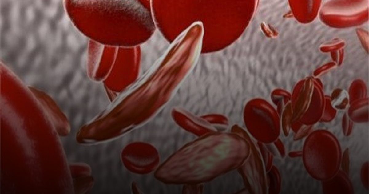 تظهر في عمر الـ 6 شهور.. أعراض مرض فقر الدم المنجلي