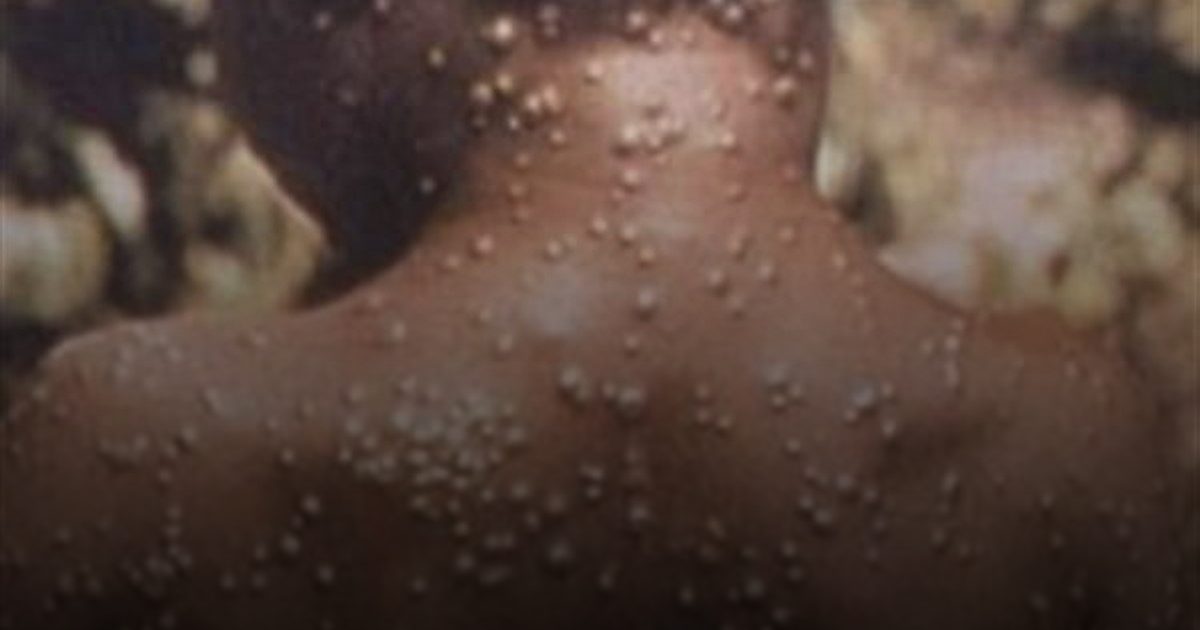 رسمياً.. "إمبوكس" يغادر قائمة الطوارئ الصحية في أفريقيا