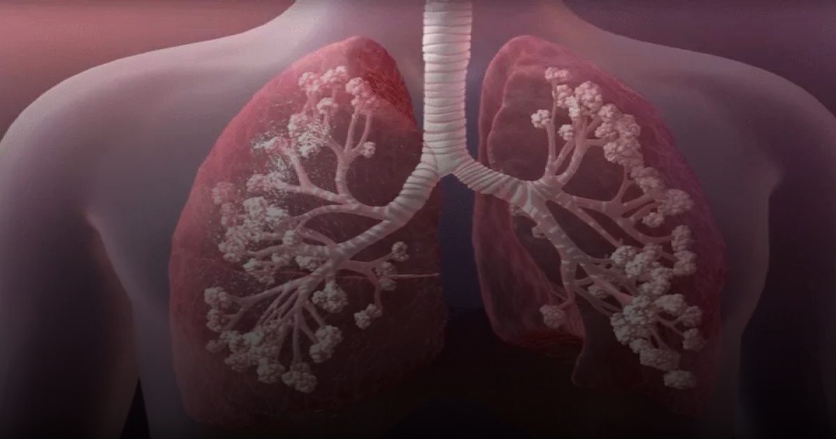 دراسة توضح .. الإصابة بتلف الرئة ترتبط بالأمراض المناعية..