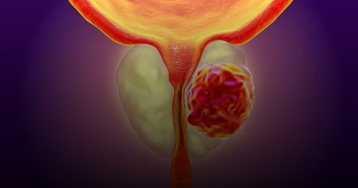 بصمة الحمض النووي.. اختبار دم مبتكر ينهي حقبة الخزعات المؤلمة لسرطان البروستاتا