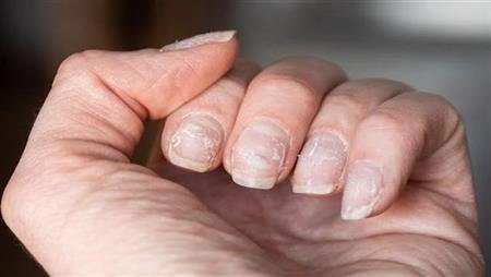 أسباب عديدة لظهور تجاعيد الأظافر