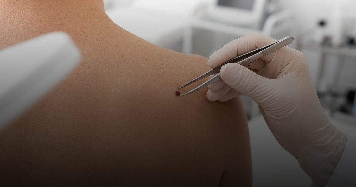 إزالة الشامات في المنزل: خطر على صحتك