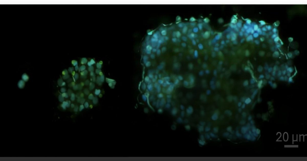 اكتشاف عنصر جديد يساهم في انتشار السرطان .. الخلايا السرطانية تسبح في الدم