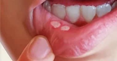 قروح الفم الصغيرة قد تخبئ خطر سرطان الفم