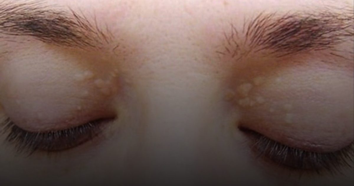 علامتان في الوجه تكشفان عن ارتفاع مستوى الكوليسترول