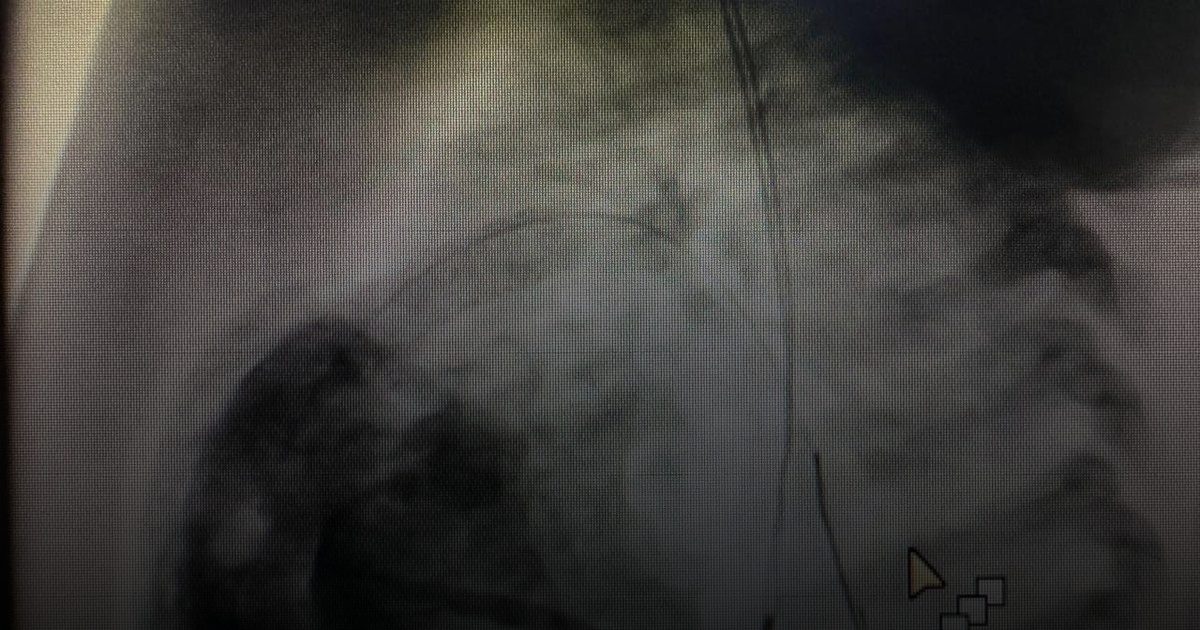 إنقاذ حياة رضيع من عيب قلبي نادر بمركز القلب بالقصيم