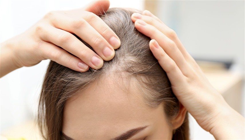 حل فعال لنوع نادر من الصلع بقليل من الأدوية