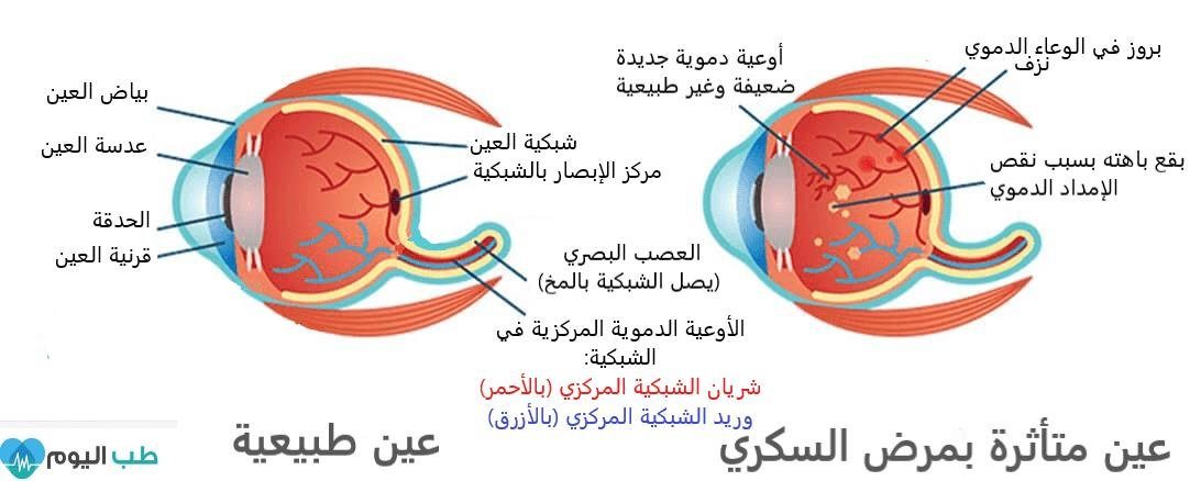 اعتلال الشبكية السكرى.. يسبب ضرراً بالأوعية الدموية في العين