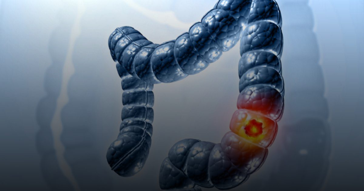 كيف يمهد "تصلب القولون" الطريق لإصابة الشباب بالسرطان؟