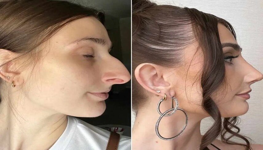 جراحة تجميل بـ11 ألف دولار .. والسعادة في الطلاق!