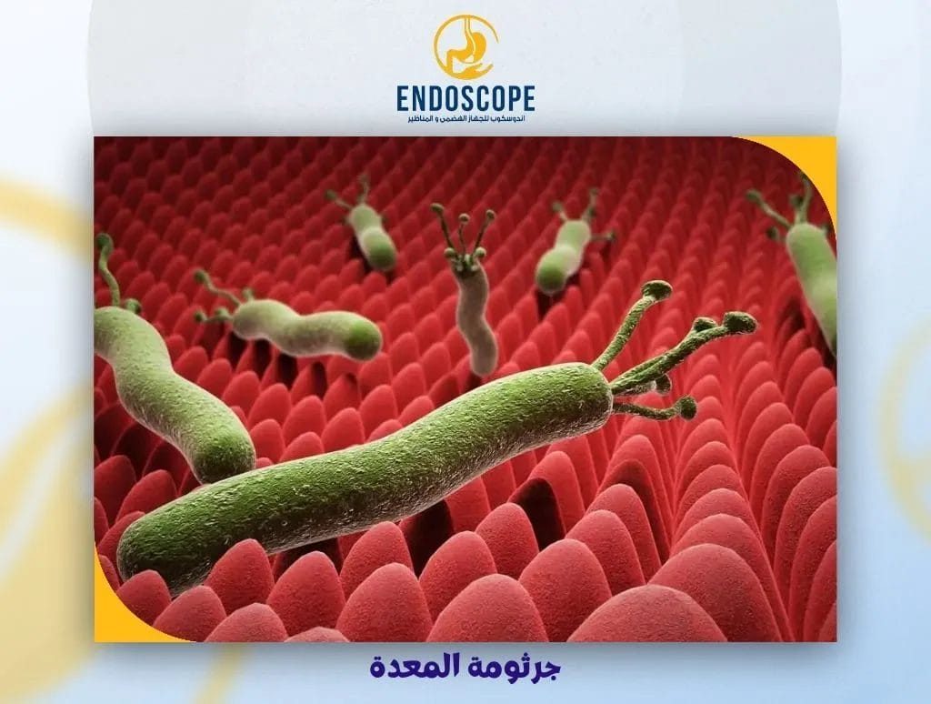 جرثومة المعدة: كيف تُصيبنا وأسرار الوقاية والعلاج الفعّال