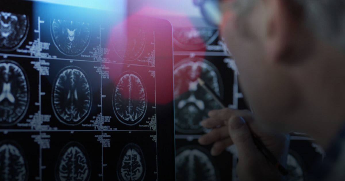 دواء "ليكانيماب" يؤخر تطور ألزهايمر 8 سنوات