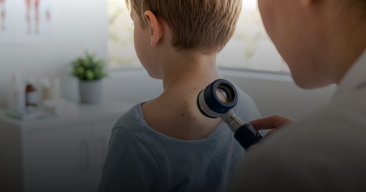 انخفاض شامات الأطفال الأستراليين بنسبة 47٪