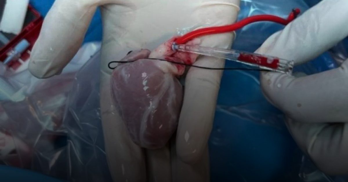 في أمريكا.. زراعة قلب جزئية تعيد الأمل  للأطفال المصابين بعيوب خلقية