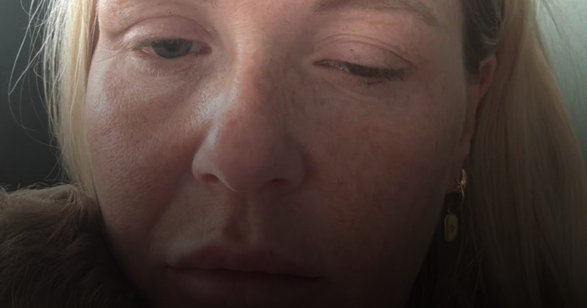 في بريطانيا.. حقن تجميل مزيفة تسبب مرضاً نادراً