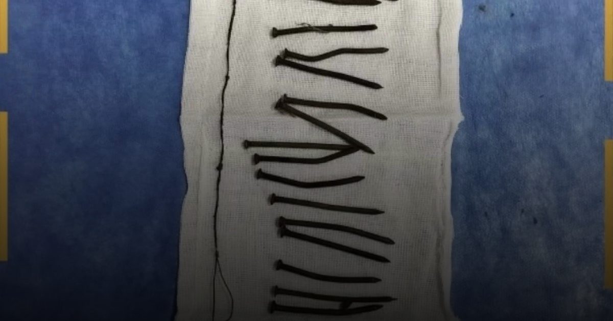 نجاح طبي بمصر في استخراج 34 مسماراً من معدة سيدة دون جراحة