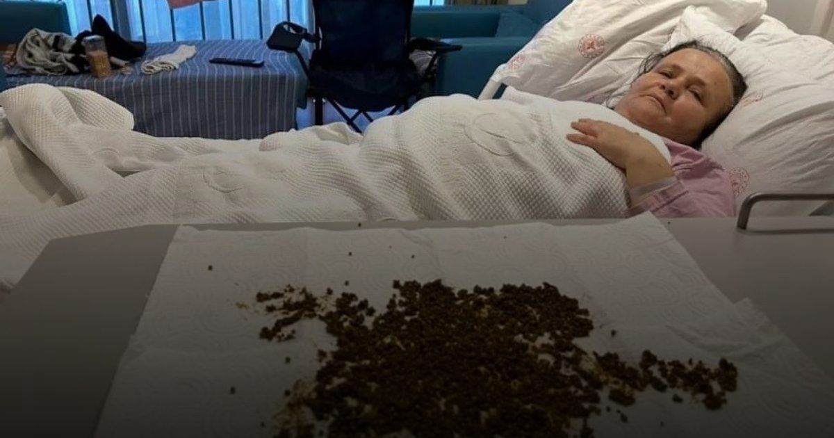 استخراج 20 ألف حصوة من مرارة مريضة