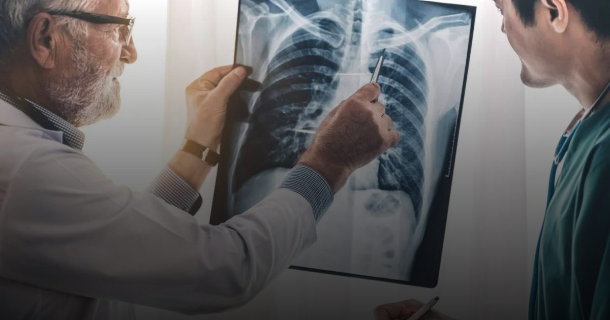 سرطان الرئة يلاحق غير المدخنين.. هذه هي الأسباب الخفية وراء تلك الظاهرة