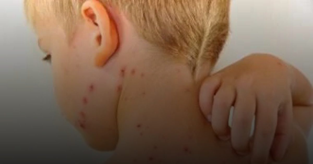 للأمهات.. كيف تحمين طفلك من الجديري المائي؟