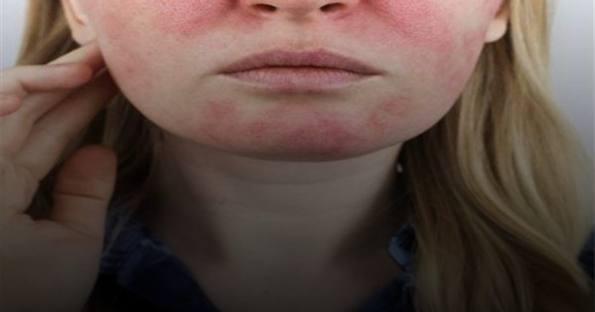 ما لا تعرفه عن «التهاب الجلد التحسسي للضوء» وأهم العلاجات