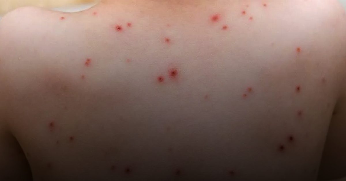 الصحة العالمية: جدري القرود يتزايد في أوغندا  بمعدل 200 لـ300 إصابة أسبوعياً