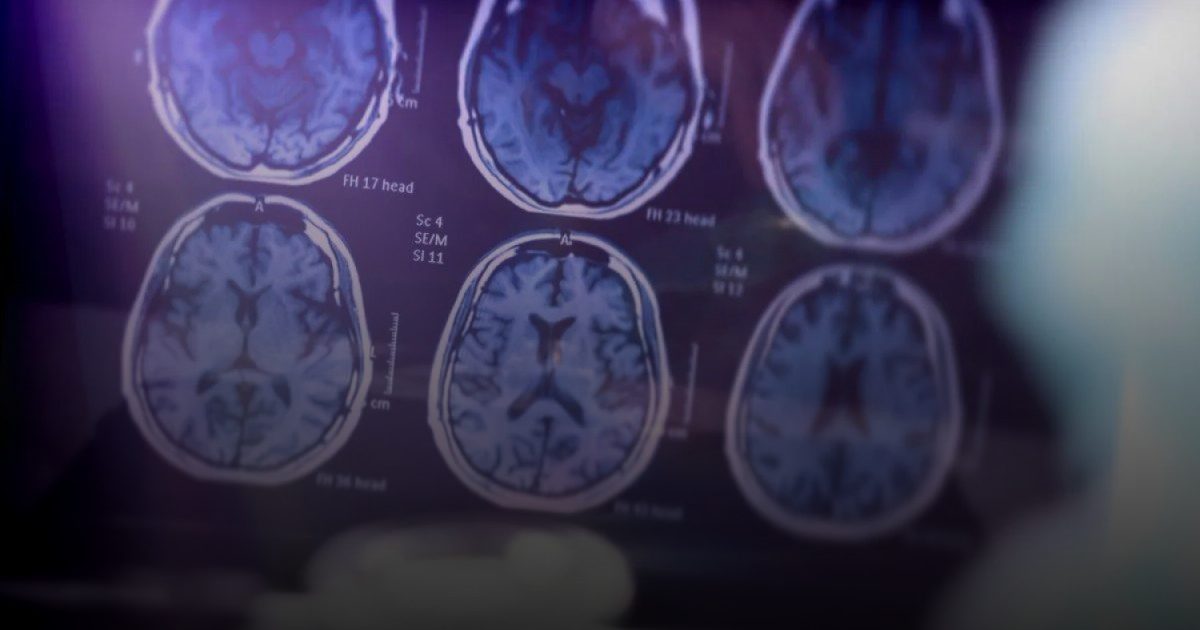 «ليكانيماب» دواء جديد يثبت فاعلية في إبطاء ألزهايمر