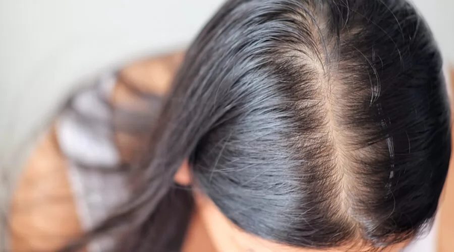 9 أسباب صحية وراء تساقط الشعر لدى النساء