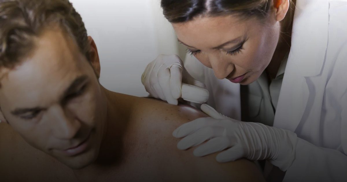 سرطان الجلد... مرض يمكن الوقاية منه وعلاجه.. البداية من الشامة