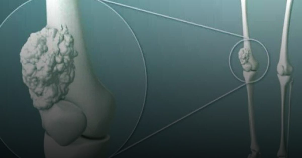 استشاري: الكشف المبكر عن سرطان العظام يزيد فرص العلاج بنسبة تصل إلى 70%