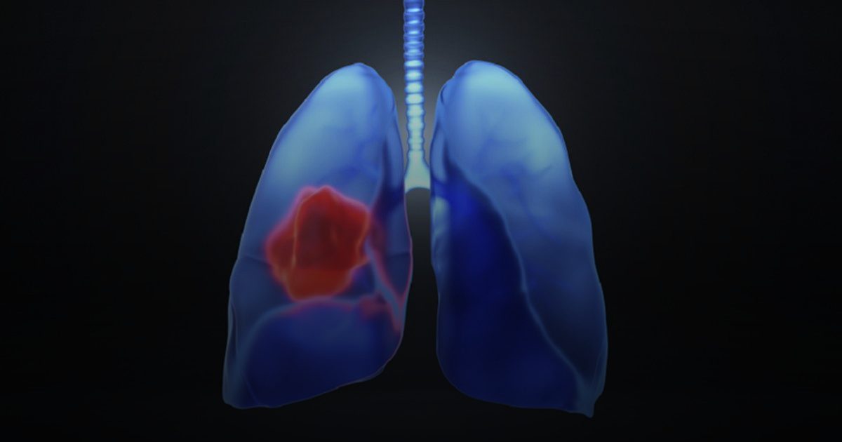 اكتشاف: "الالتهاب" سبب رئيسي لظهور سرطان الرئة في مراحله المبكرة