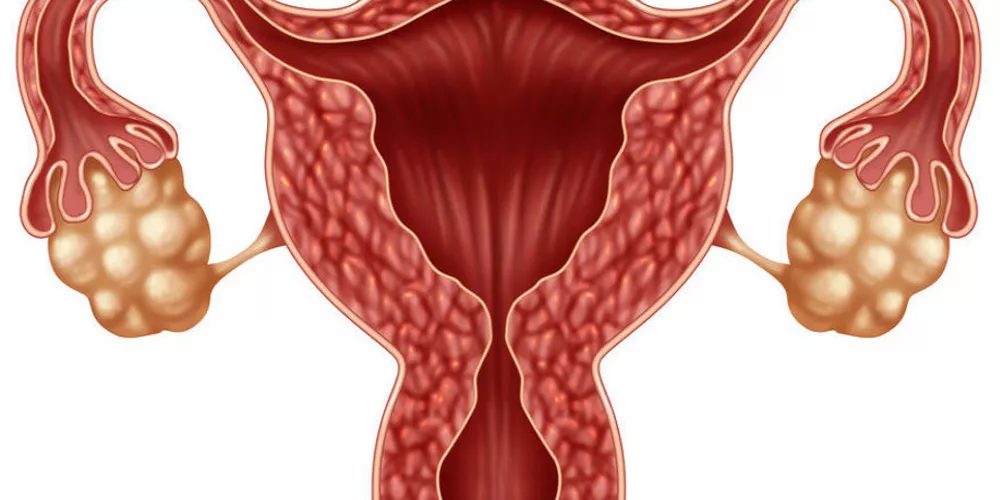 الصيام المتقطع يحسن صحة المصابات بمتلازمة تكيس المبايض