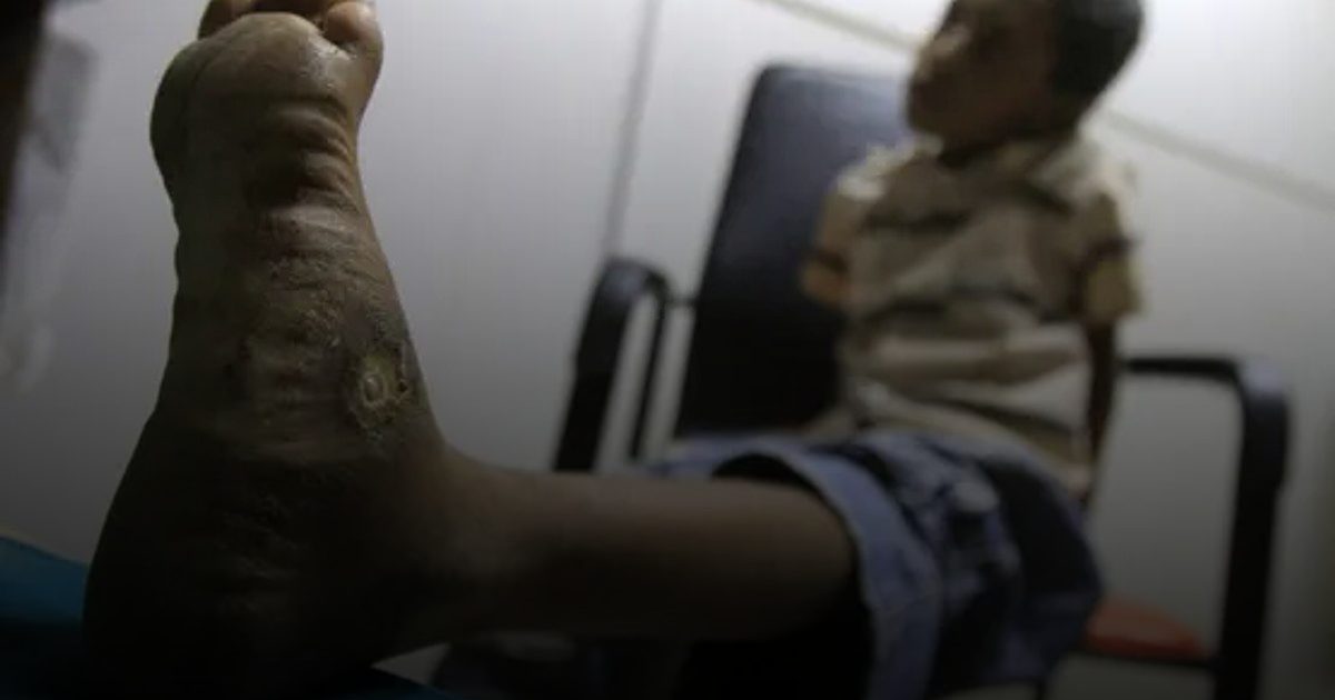 الصحة العالمية: التوصل لعقار جديد لمرض "الميسيتوما" الذي يؤدي لبتر الأطراف