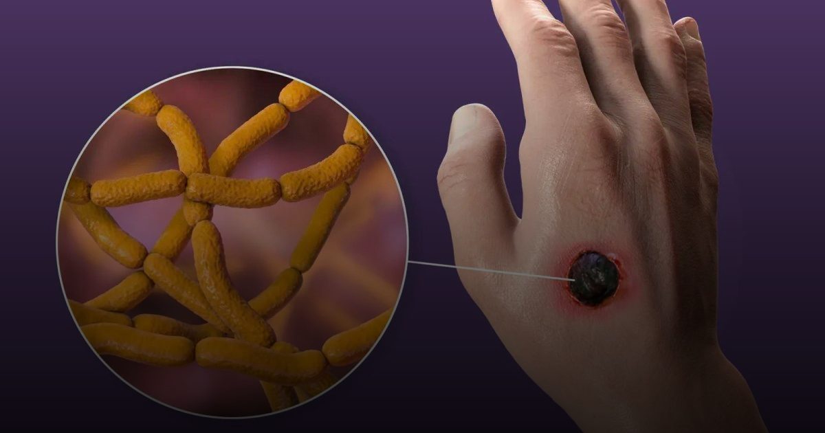 وفاة و16 إصابة بالجمرة الخبيثة تثير قلقاً في الكونغو الديمقراطية