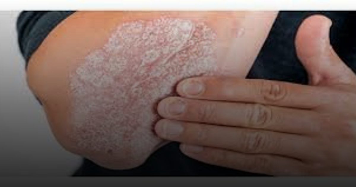 في يومها العالمي ..أفضل خيارات العلاج للصدفية بأنواعها