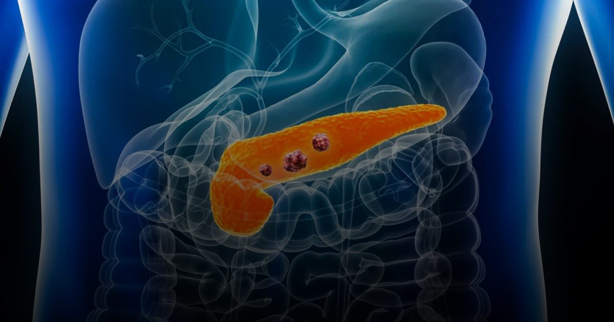 زرع خلايا بنكرياسية يمكّن مريضاً بالسكري من إنتاج الإنسولين بنفسه