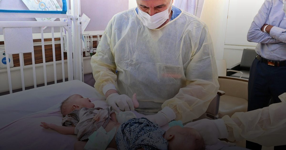 عملية فصل التوأم الصومالي تبدأ في الرياض