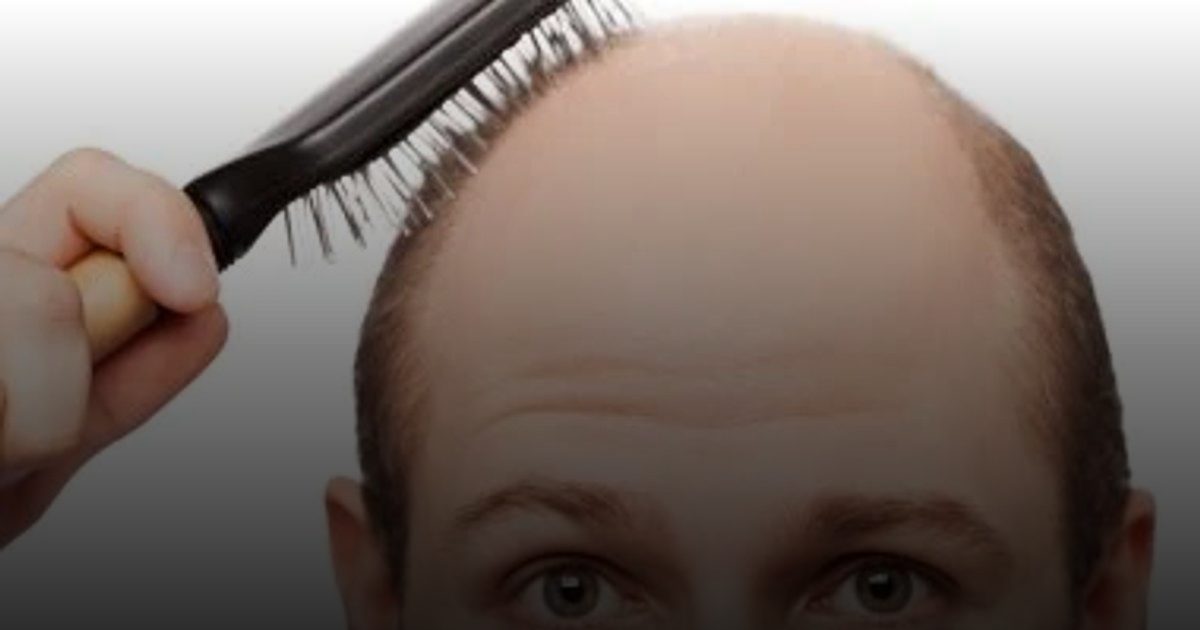 الصلع الوراثي عند الرجال.. الأسباب وطرق العلاج