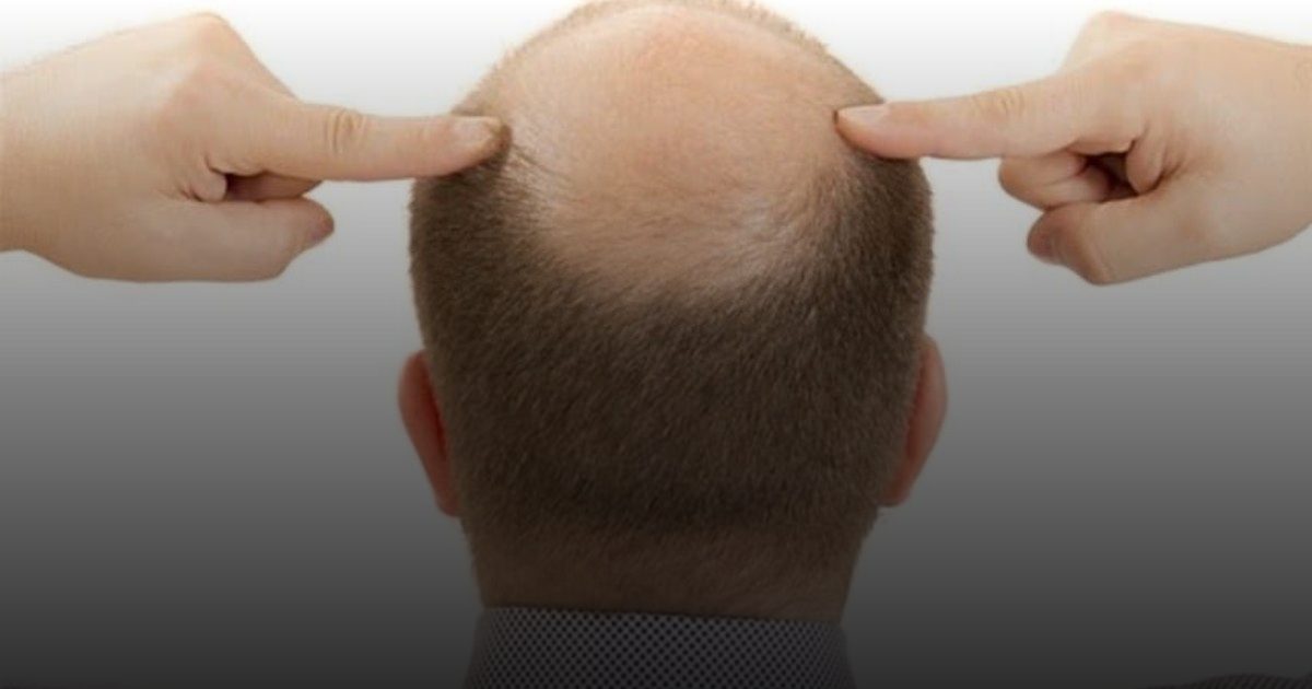 أمل جديد لمصابي الصلع: مصل مبتكر يُعيد نمو الشعر في 20 يوماً وفقاً لدراسة تايوانية