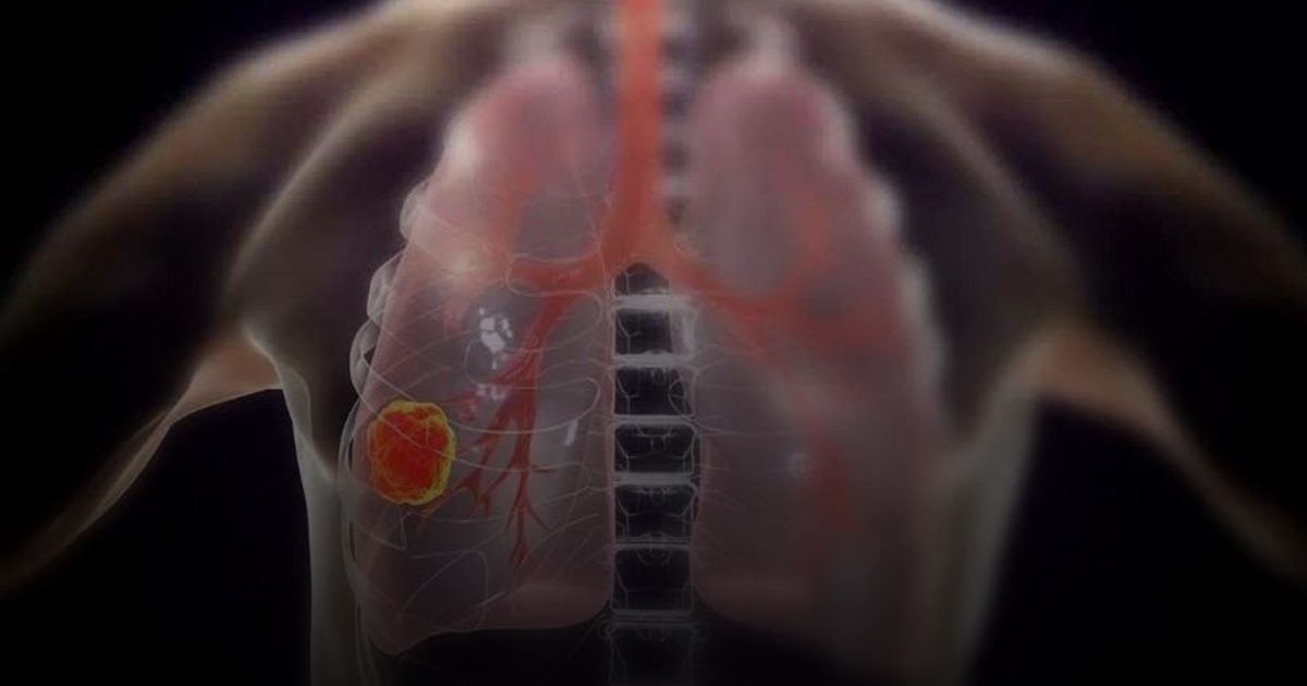 علماء من كوريا ينجحون في تطوير علاج نانوي مبتكر يستهدف خلايا سرطان الرئة