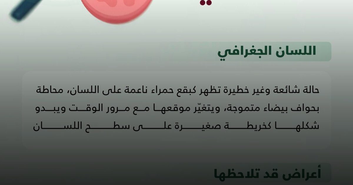 "اللسان الجغرافي": أعراضه وأسباب ظهور البقع الحمراء على سطح اللسان