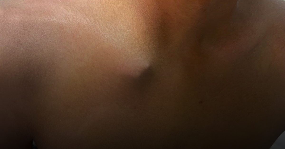 "مدينة الملك سعود الطبية" تُنقذ شاباً من إصابة خطيرة في مفصل الترقوة