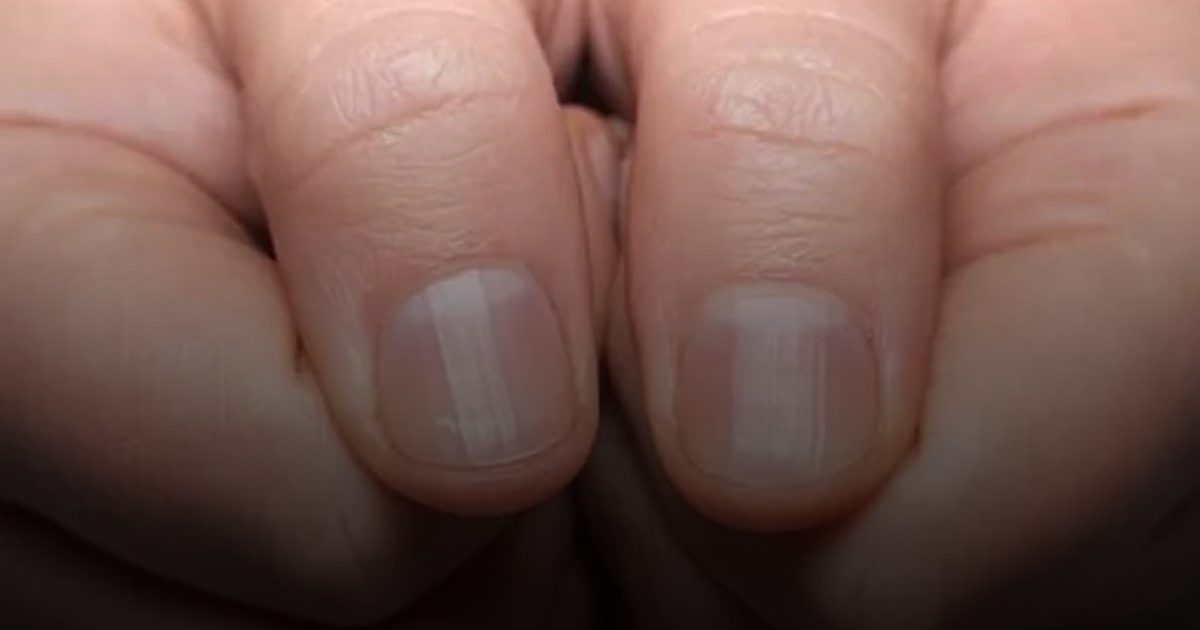 أعراض تحذيرية للنوبة القلبية قد تظهر على أظافرك