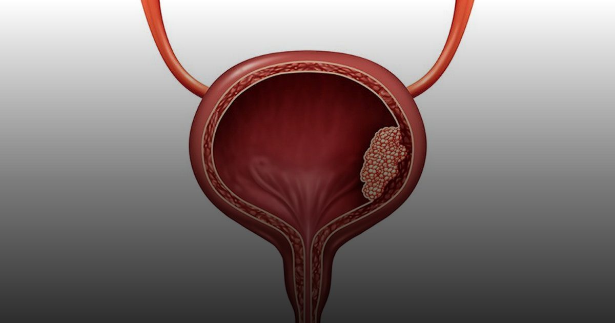 التهاب المثانة بعد العلاقة "الحميمية"