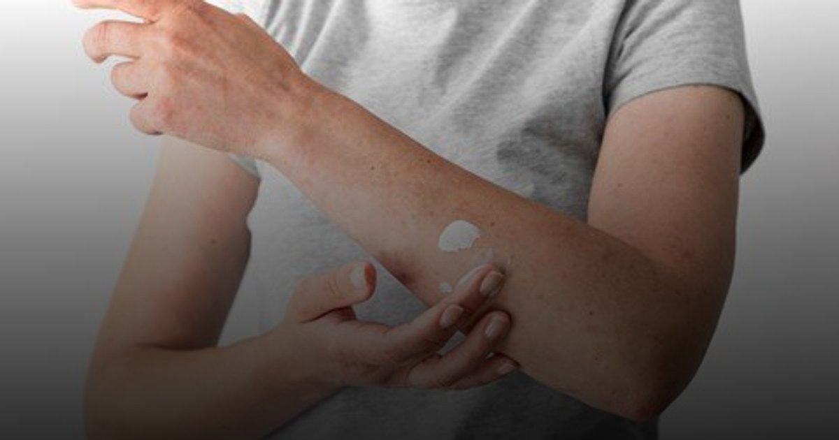 "الشهر العالمي للصدفية" يدعو لمكافحة الوصمة وتعزيز بيئة الفهم والدعم للمصابين