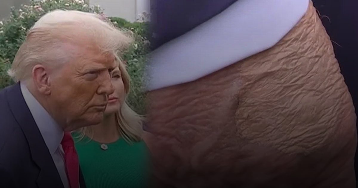 علامة غامضة على يد ترمب تثير القلق والتكهنات الطبية