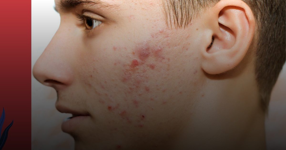 وداعًا لحَب الشباب: ابتكار علاجي جديد يقضي عليه في 7 أيام فقط