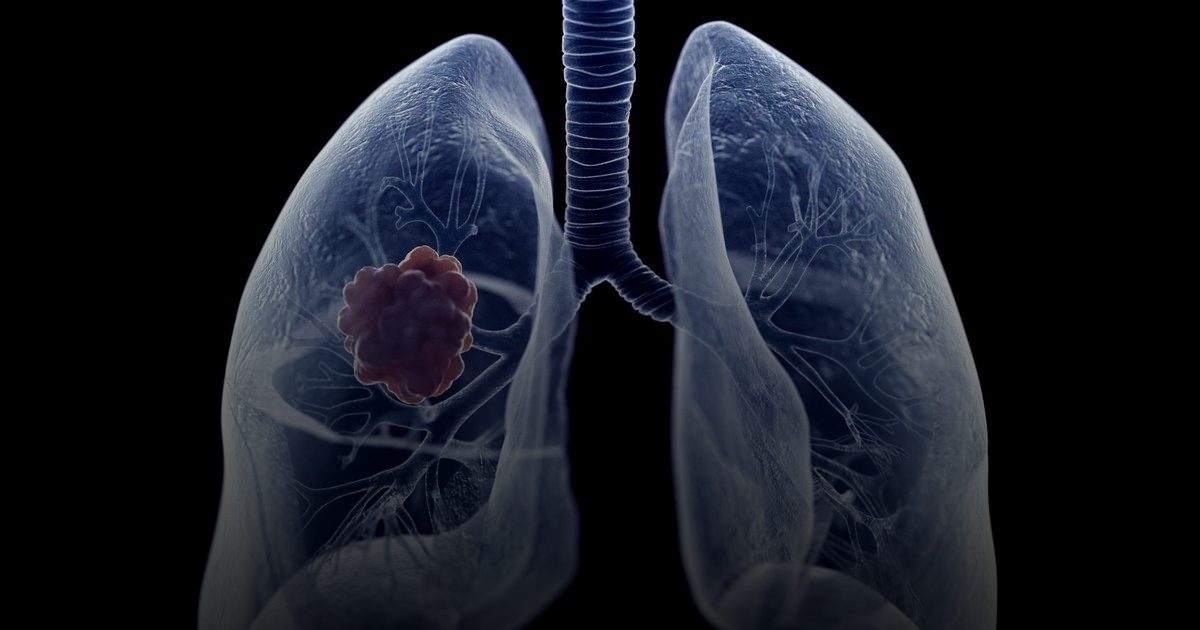دواء مناعي تجريبي يفتح أفقاً جديداً لعلاج سرطان الرئة